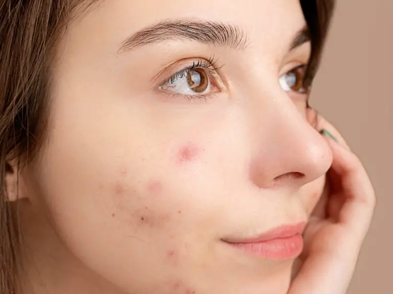 Why Acne Comes Back after Accutane and How to Prevent It (2023)