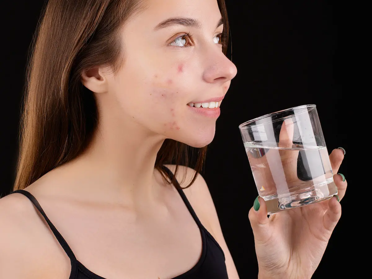 does drinking water help acne scars
