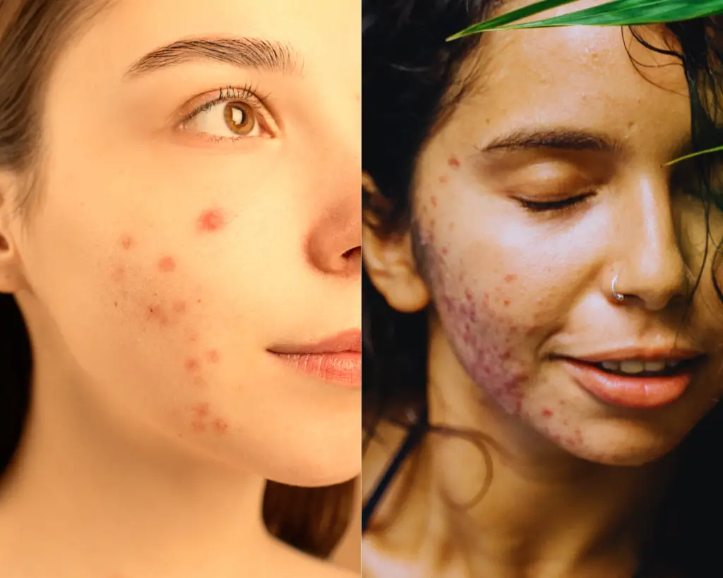 What is the Difference Between Acne Marks vs. Acne Scars?(2023)