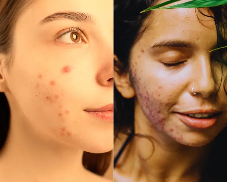 What is the Difference Between Acne Marks vs. Acne Scars?
